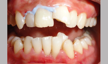 Teeth whitening in Anand
                